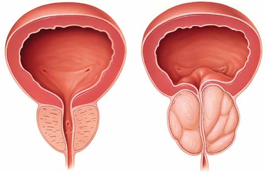 Próstata normal e inflamación de la próstata (prostatitis crónica)