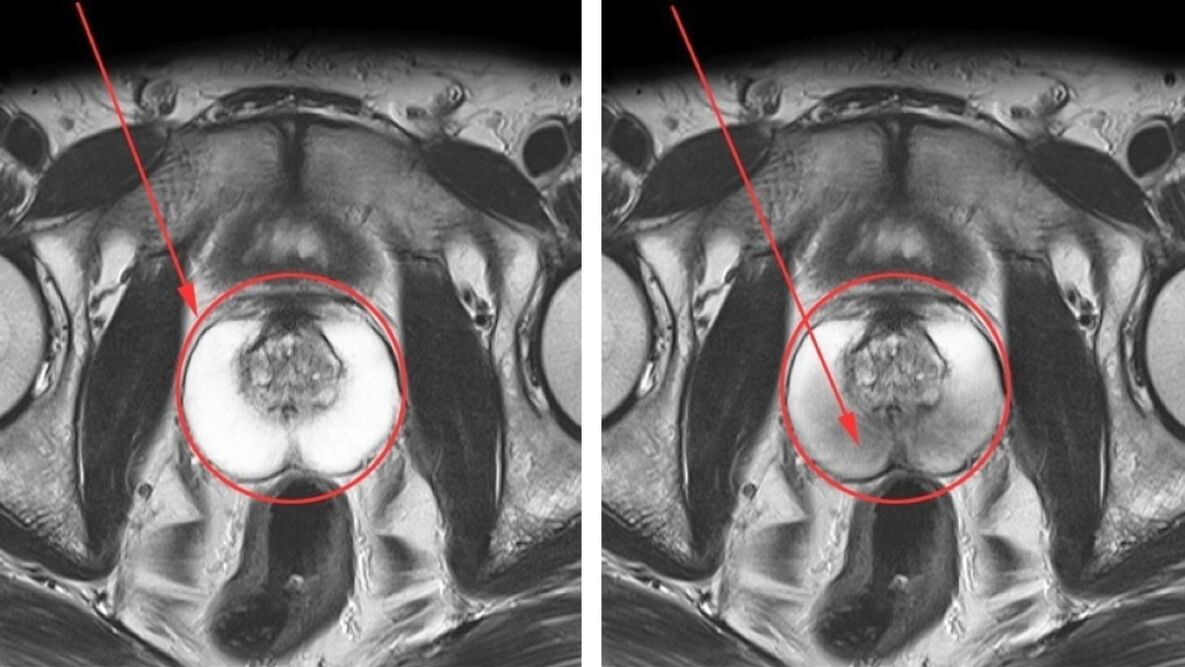 Ultrasonido para prostatitis crónica próstata sana (izquierda) e inflamada (derecha)