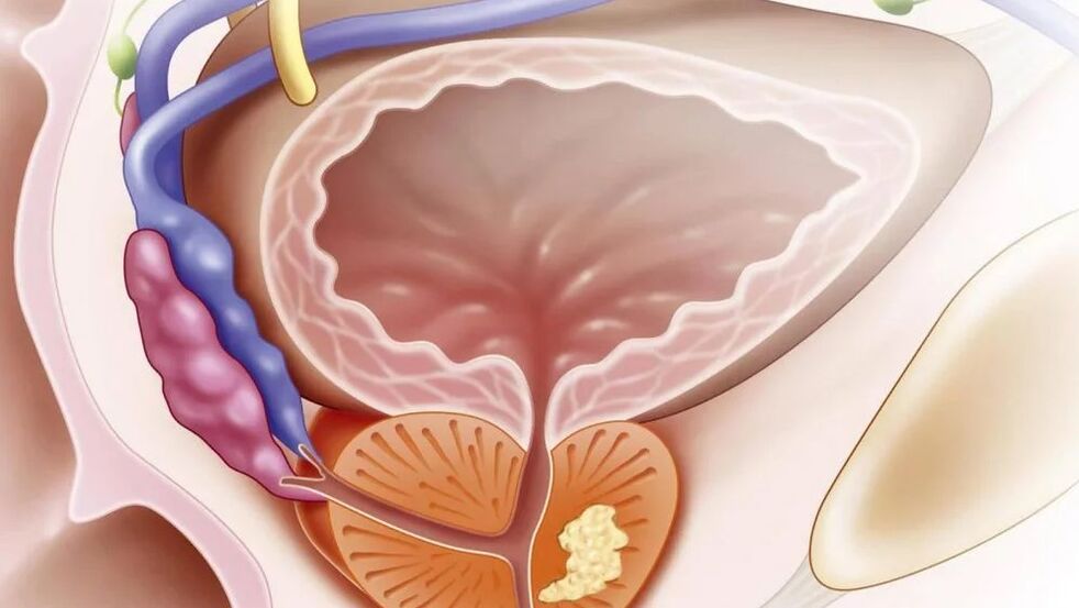 Prostatitis crónica nabacteriana