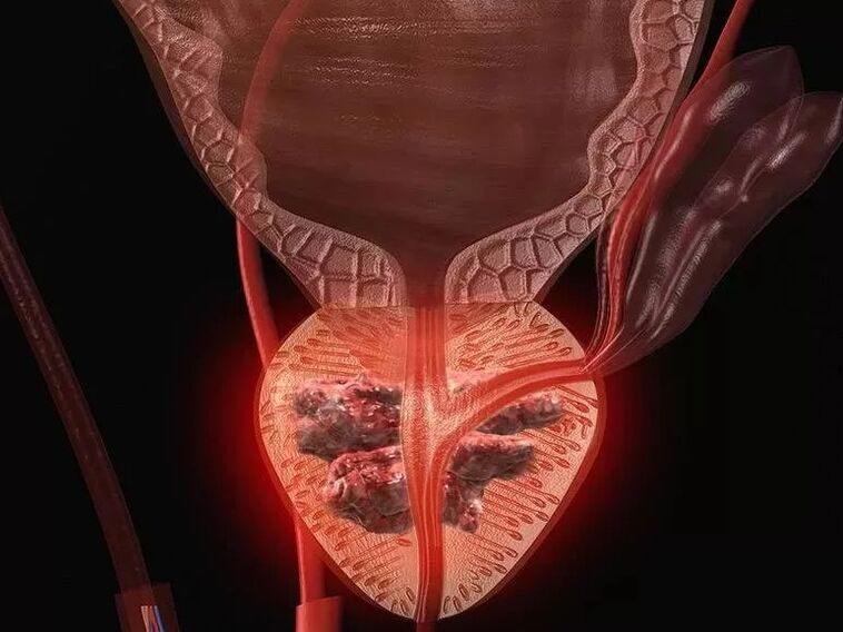 Prostatitis en hombres