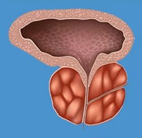 Signos característicos de prostatitis