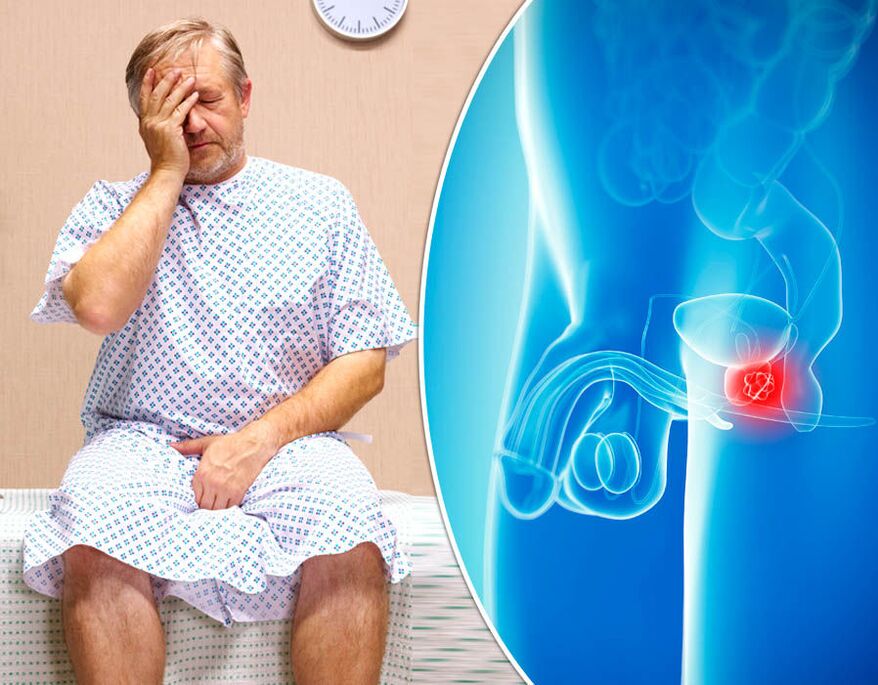 Un hombre con prostatitis se somete a un diagnóstico de la enfermedad.