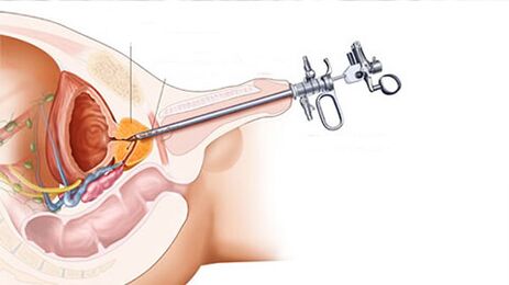 Tratamiento quirúrgico de la prostatitis