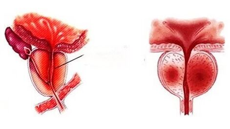 ¿Cómo se ve la prostatitis crónica